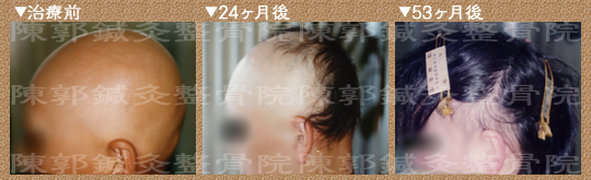 円形脱毛症症例 全頭性(悪性) 男性