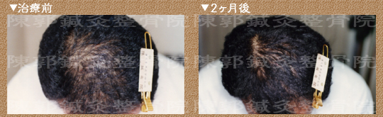 脱毛症症例 若年性脱毛症 男性 40代 奈良県在住